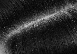 hairfall-dandruff